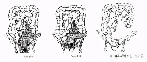 miles(切除肛门,结肠造瘘):适用于超低位Ⅱ期,Ⅲ期直肠癌和肛管癌