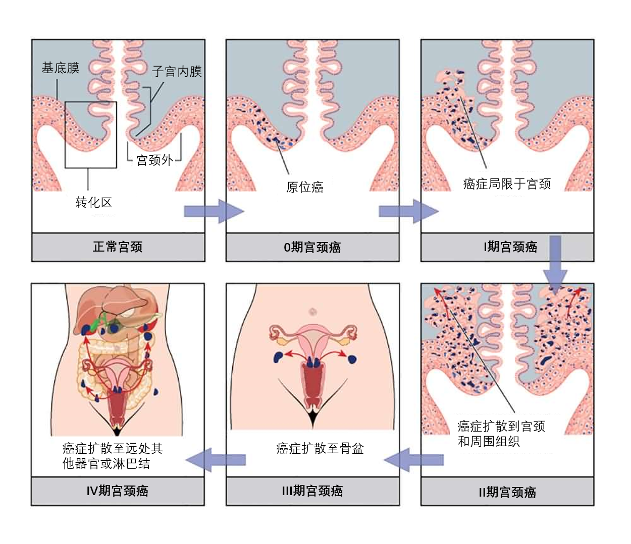 一文读懂宫颈癌的分期,明明白白接受治疗