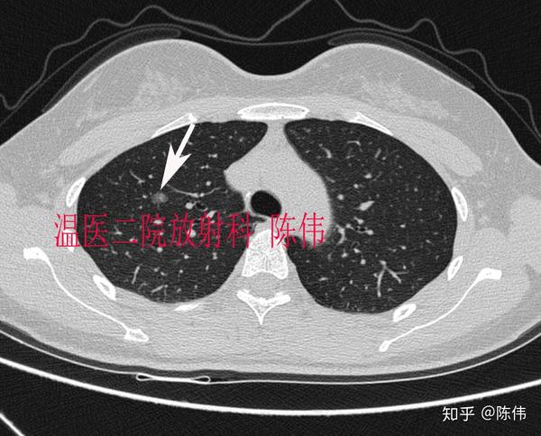 4例肺癌的典型影像学表现
