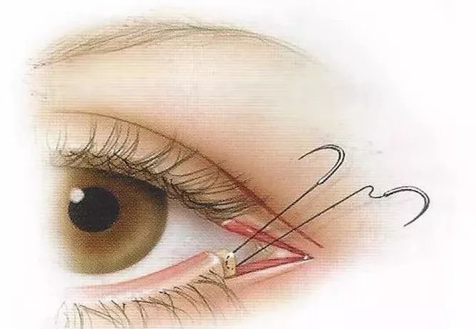 根据每个人的眼部状况不同,在实行开外眼角时所采取的方式也有所不同