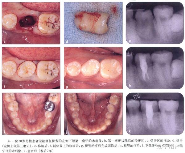 要尽快拔了蛀牙吗