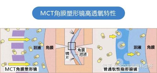 mct角膜塑形镜青少年视力解决方案