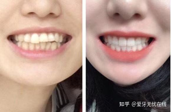 在深圳有什么是牙齿矫正正畸后才发现的事矫正牙齿多少钱有没有医生