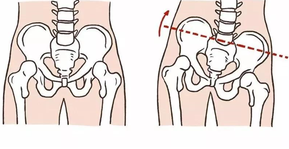 三个步骤纠正骨盆侧倾