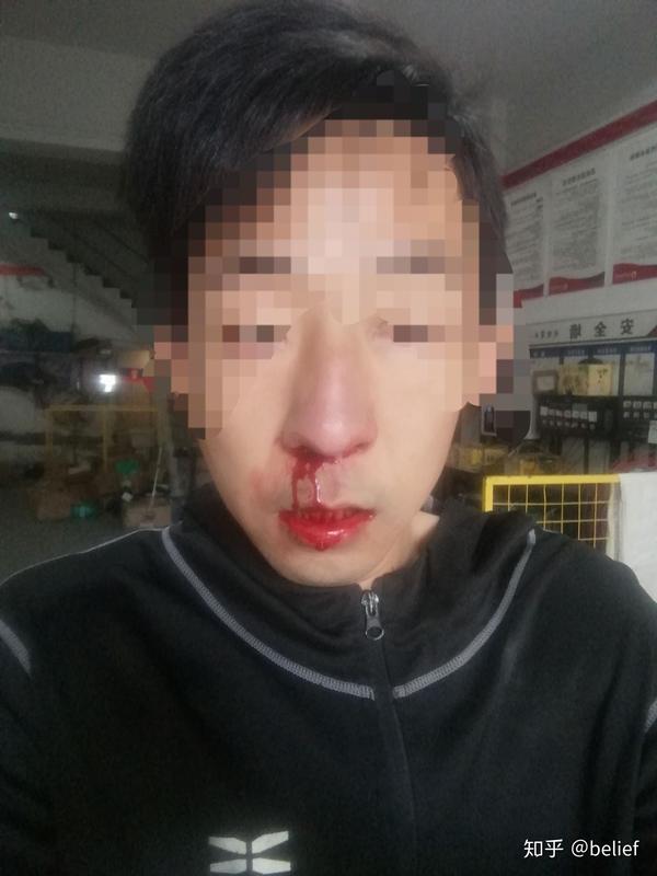 打架结果鼻骨骨折枕骨骨折的经历