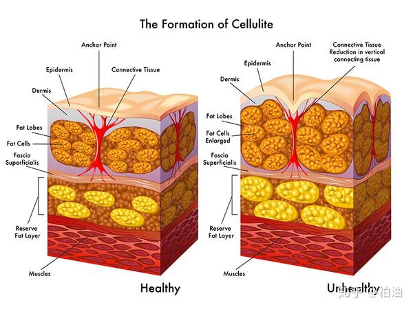 直接因素是皮下脂肪堆积和结缔组织强度厚度不一导致的脂肪不均匀分布