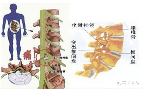 问题一:腰椎间盘突出症,为什么会腿疼?