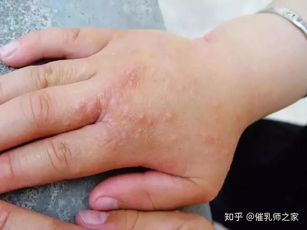 汗疱疹是一种发生于儿童手足掌,指(趾)间皮肤的复发非感染性水疱病