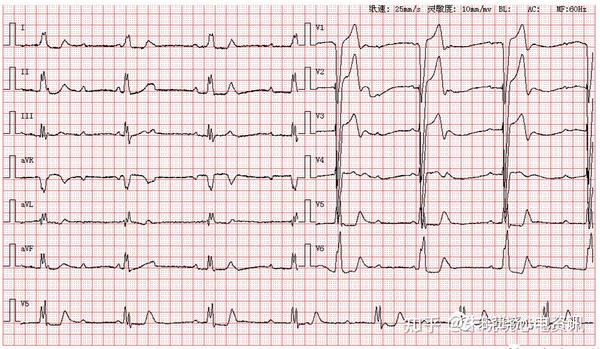 患者女,73岁,图为其入院体检心电图