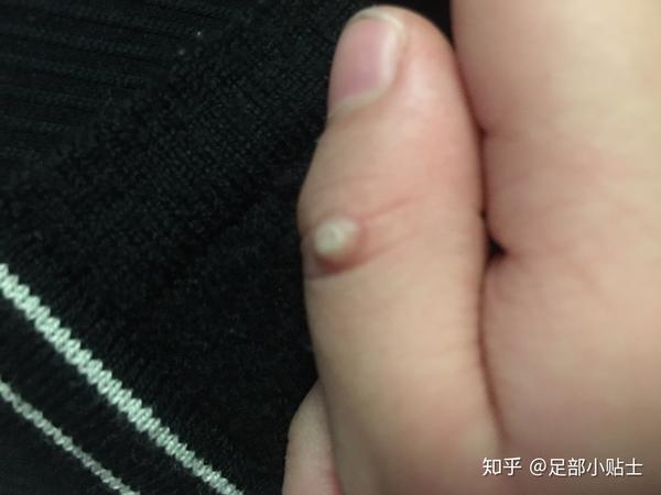 宝妈们注意了孩子脚上这些不是鸡眼不要盲目用鸡眼贴