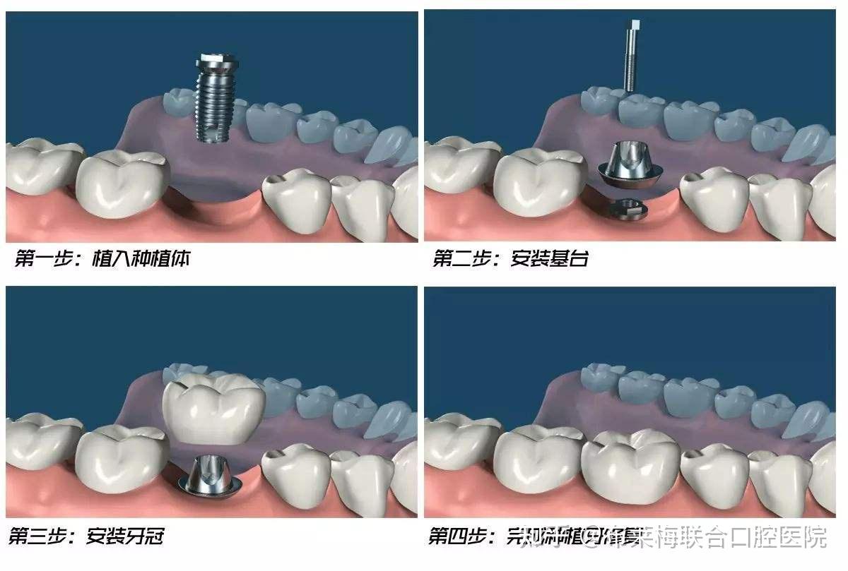 牙齿修复的方式越来越精细化,其中近年比较盛行的种植牙修复,不知道