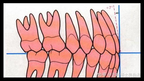 上下切牙的关系和转距角   以上是正常的牙齿的排列角度和倾斜度