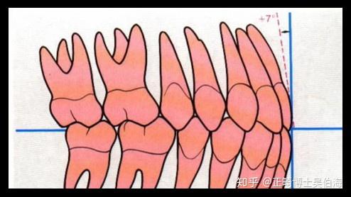 以上是正常的牙齿的排列角度和倾斜度,供各位参考