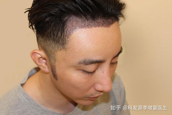 发际线高 发际线后移 鬓角种植,科发源植发恢复分享