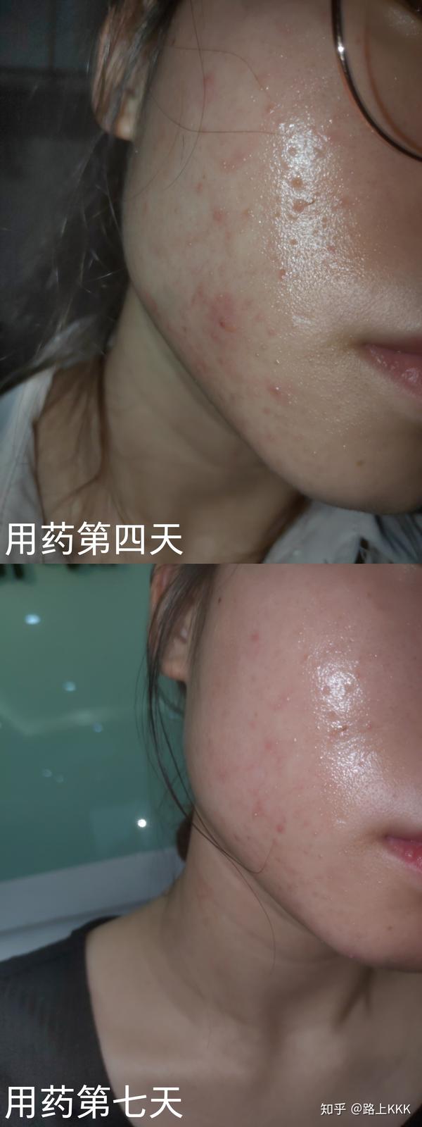 病例分享记录下自己脸潮红长闭口粉刺痘痘丘疹到恢复的过程