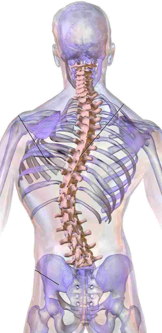 脊柱侧弯的物理治疗过程