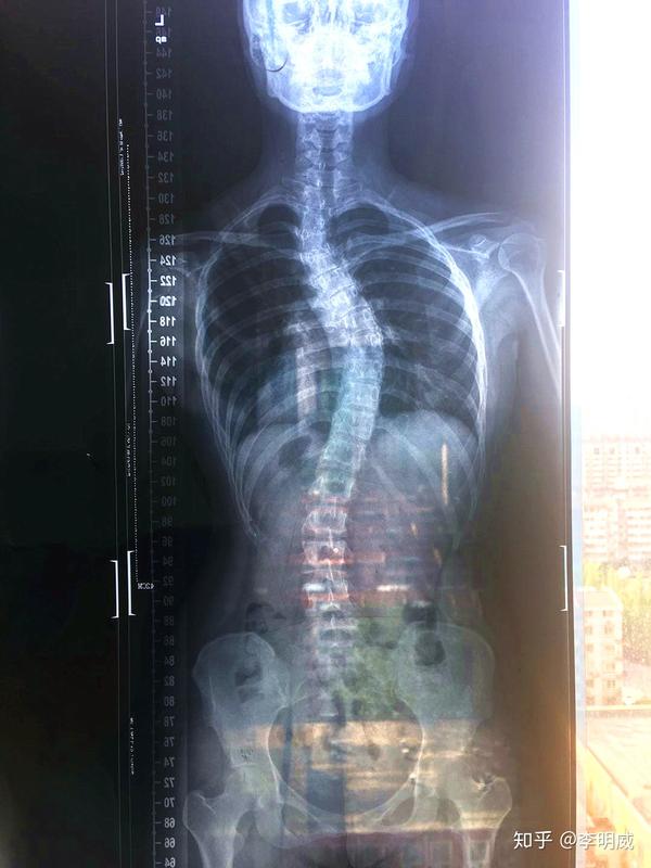 一个脊柱侧弯患者的案例分析