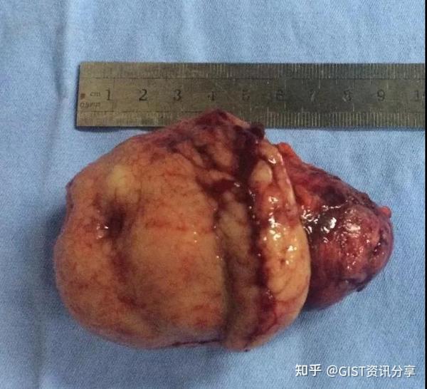 图一 胃肠间质瘤的表面可见凹陷性溃疡,此类患者应该避免腹腔镜下切开