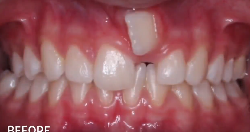 十种畸形牙正畸前后的对比你属于哪种