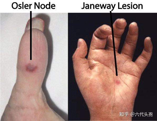 osler结节(osler's node):是一种常见于指(趾)端肉质部位的红色