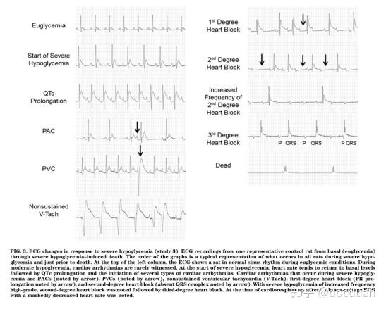 一只具有代表性的大鼠在严重低血糖引起死亡过程中心电图变化过程