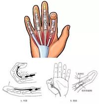 骨科医生刘明 47人 赞同了该文章 手指腱鞘炎实际上同时存在肌腱炎