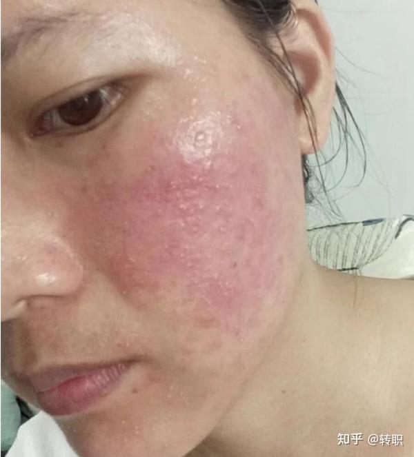 皮肤容易泛红敏感不要慌这几个护理小技巧帮你解决