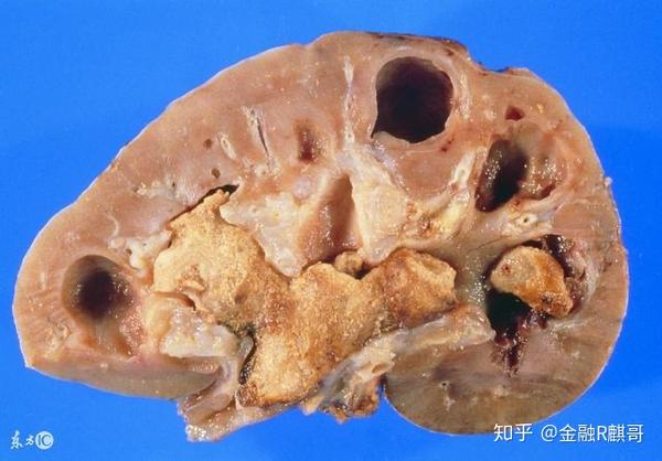 肾结石痛如腰斩!肾结石5大症状,预防肾结石这样吃