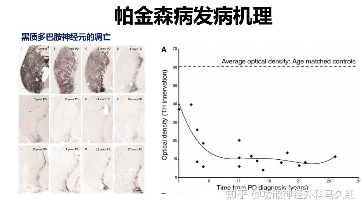 是目前我们认为导致帕金森病病理改变的主要原因