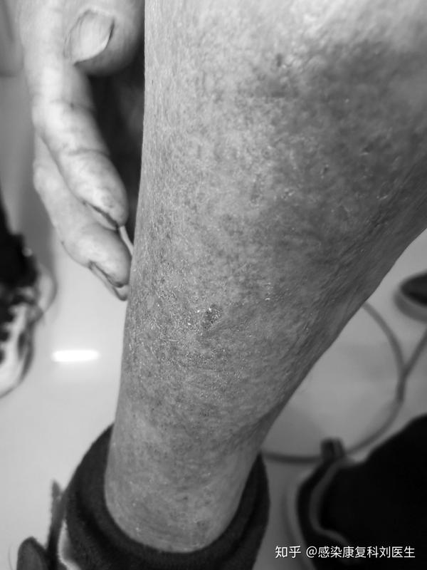 艾滋病确诊抗病毒治疗后出现皮疹,瘙痒,是什么原因?