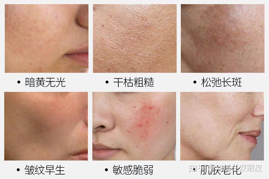 关于光子嫩肤的一切看完全明白了