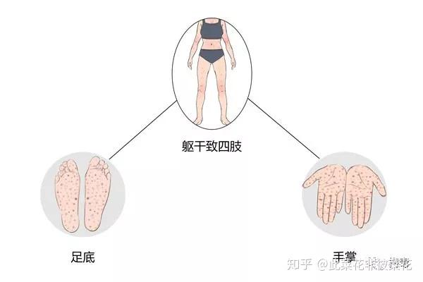 如何辨别身上的"红斑红点"是不是梅毒疹?