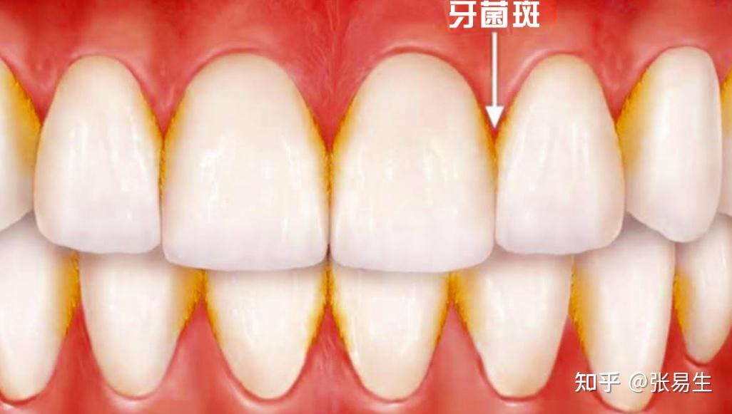 牙周炎常见的症状有哪些?