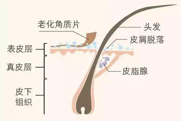 头皮的烦恼春风吹又生的头皮屑