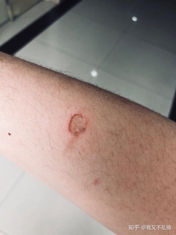 烟头烫在身上是怎样的?