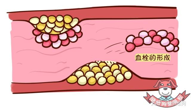 血栓的特点是天生好堵!