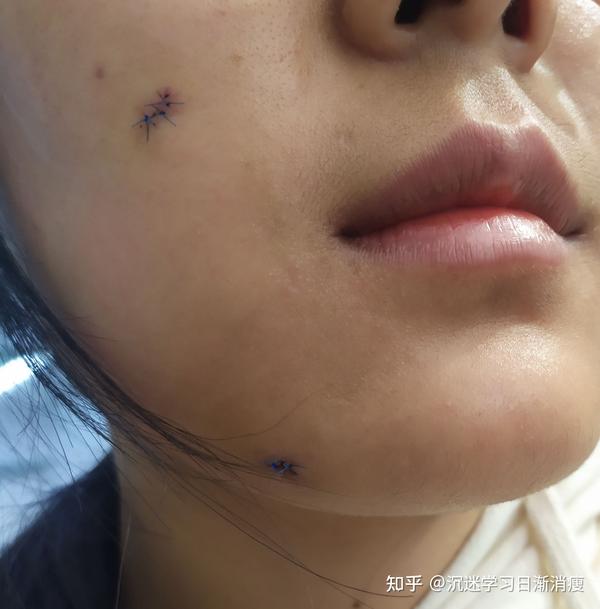 上海⑨院激光点痣手术去痣恢复记录