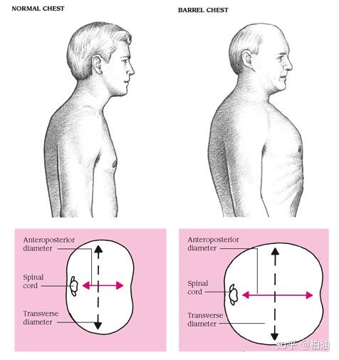 这种症状被称为桶状胸,严重者的胸廓的前后径可能和左右径差不多.