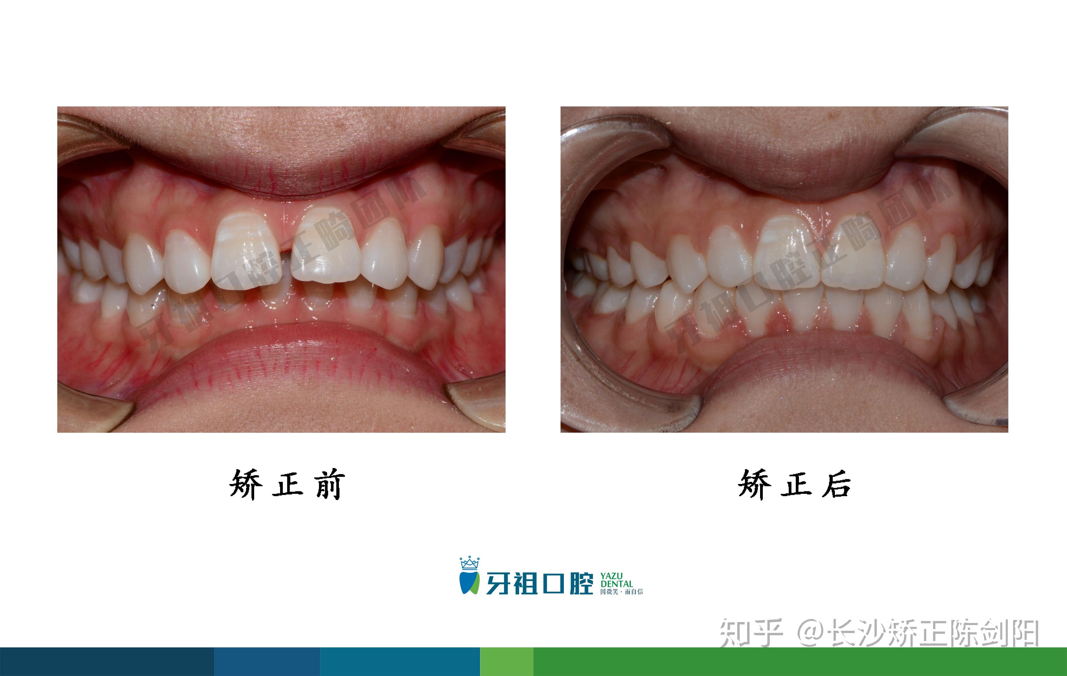 治疗过程:佩戴金属自锁托槽,矫正周期10个月接下来就是各种各样的对比