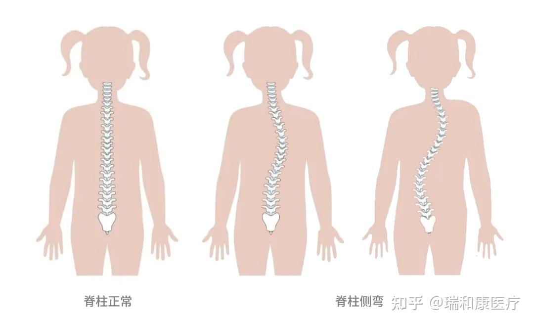 呈 "c"形或 "s"形弯曲,是儿童青少年中最常见的脊柱畸形,年龄段多集中