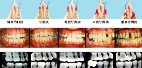 拔牙会不会影响到整个口腔的牙齿的牙齿松动呢?