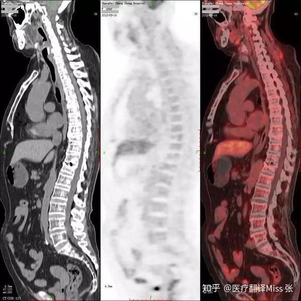 什么人群适合做pet-ct?