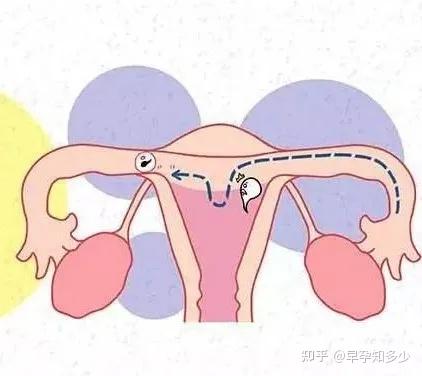 宫外孕是怎么回事儿?