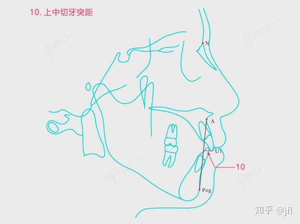 2.8 l1 to occlusal plane 下中切牙下颌平面角(impa l1-mp) 2.