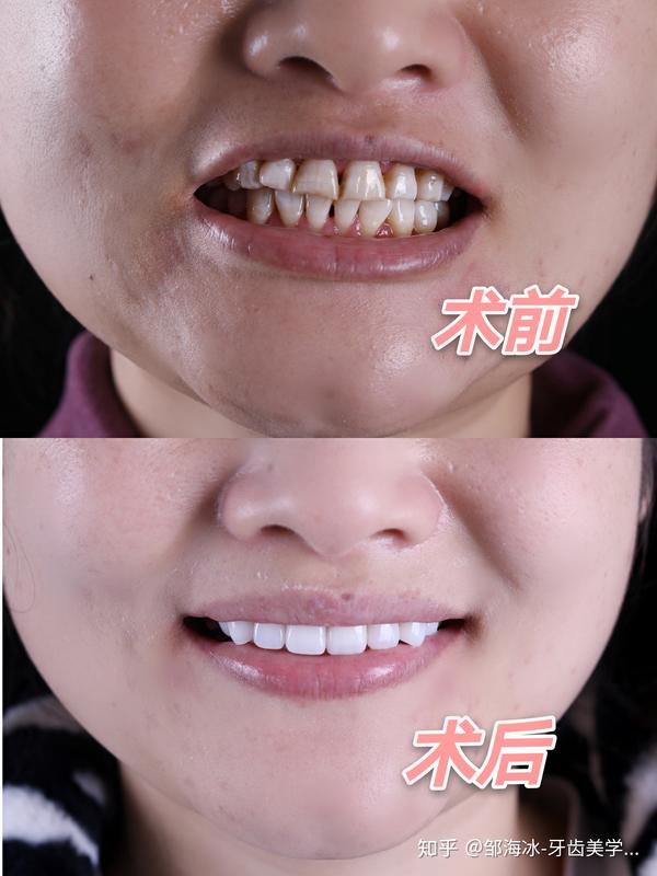 的改善,是利用全瓷贴面,调整牙齿形状,因为夜磨牙门牙已经出现变形