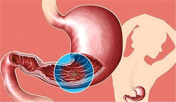 胃溃疡反复发作,一定要小心癌前病变的可能!