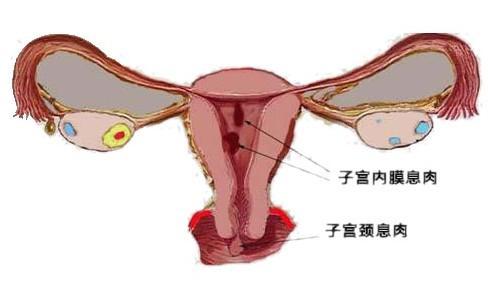 子宫内膜息肉对生育的影响