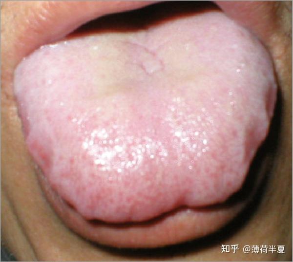 (1)舌象特征 舌体比正常的大而厚,伸舌满口,称为胖大舌;胖大舌常伴有
