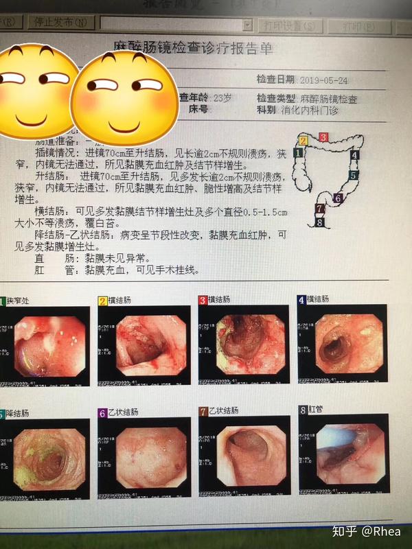 艾伯维apt-494服药三个月后的肠镜检查克罗恩