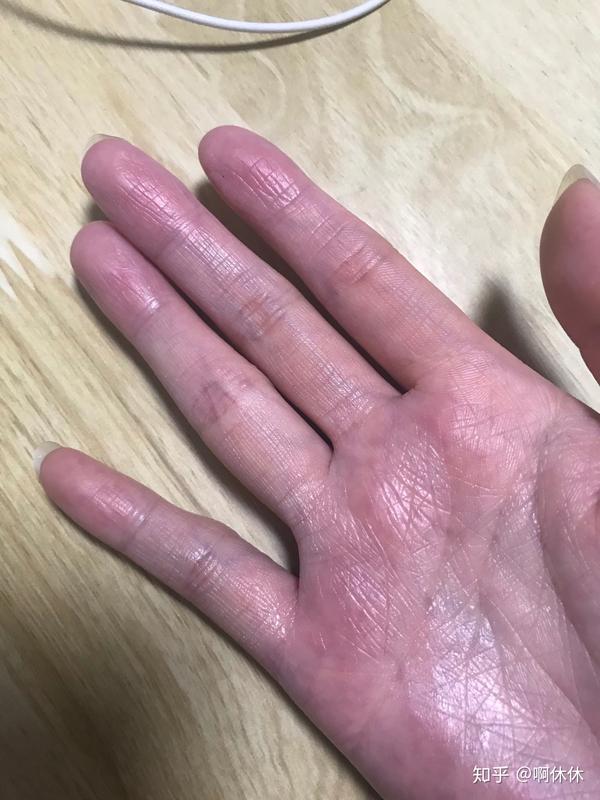 脱皮的右手↑(为了防止手干,我涂了一点修正的冻疮膏,防干裂的,所以看